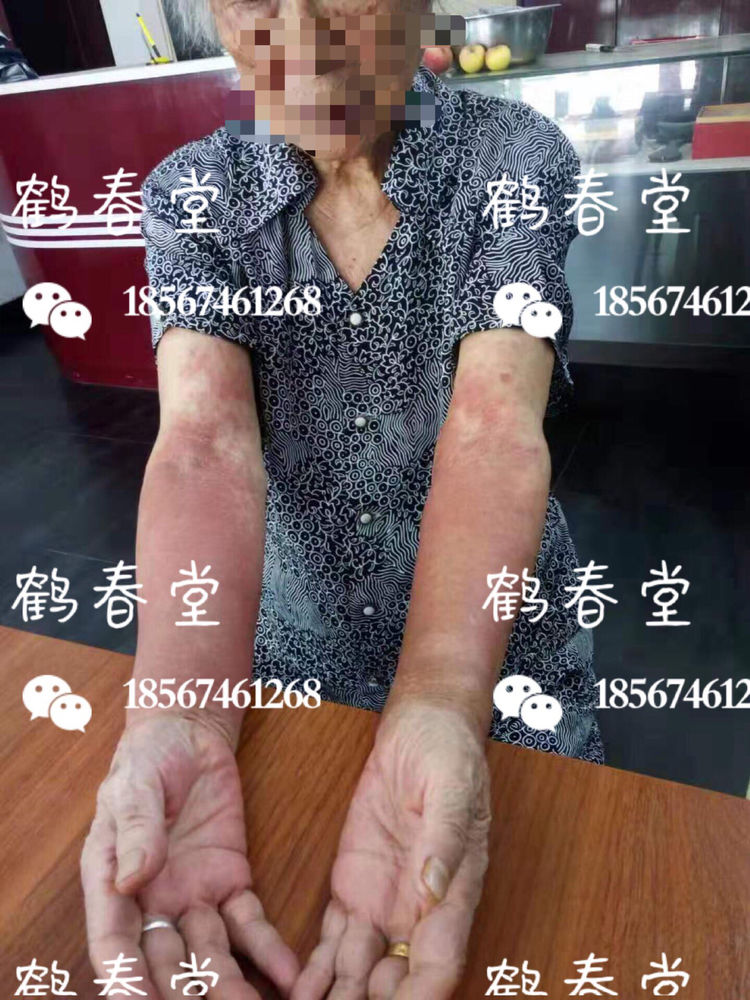 87岁老人湿疹治疗(图1)
