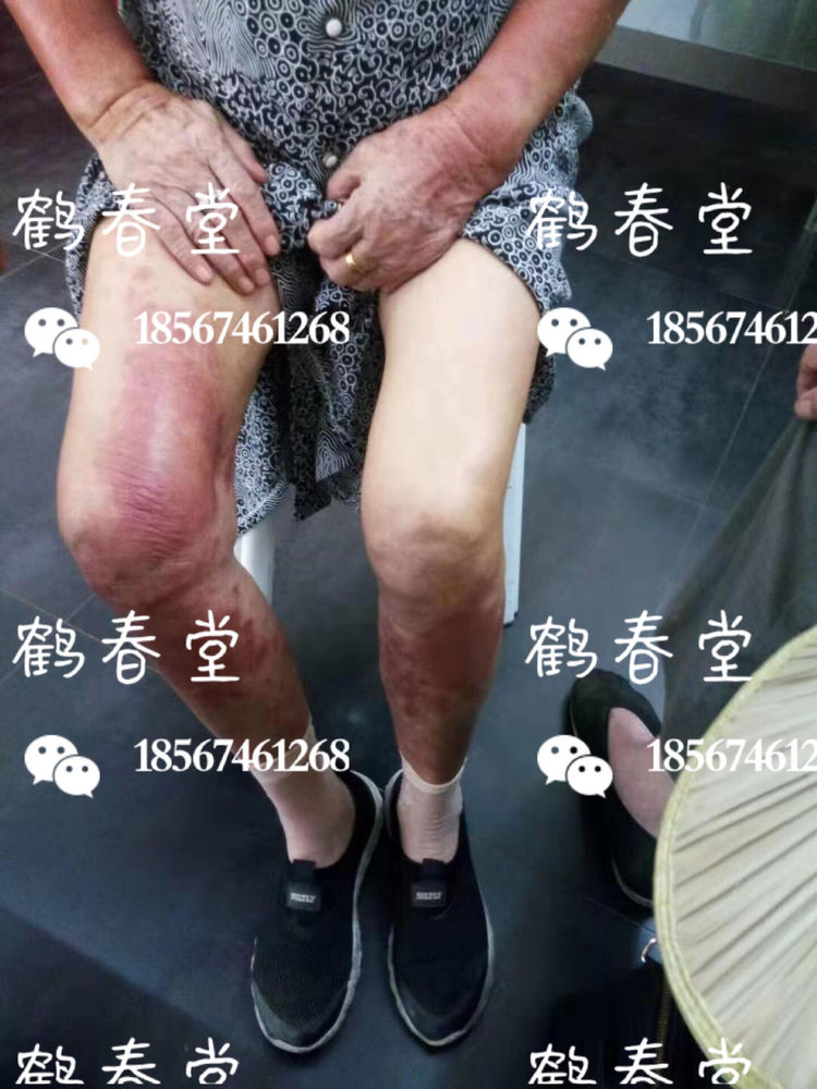 87岁老人湿疹治疗(图2)