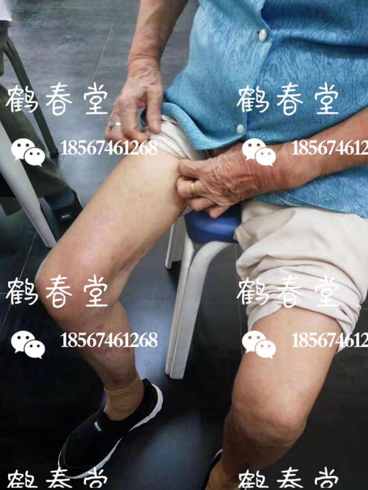 87岁老人湿疹治疗(图4)
