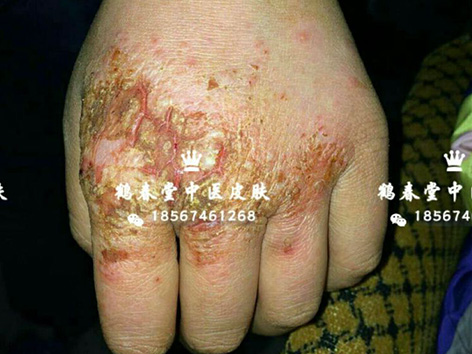 手部皲裂性湿疹三年